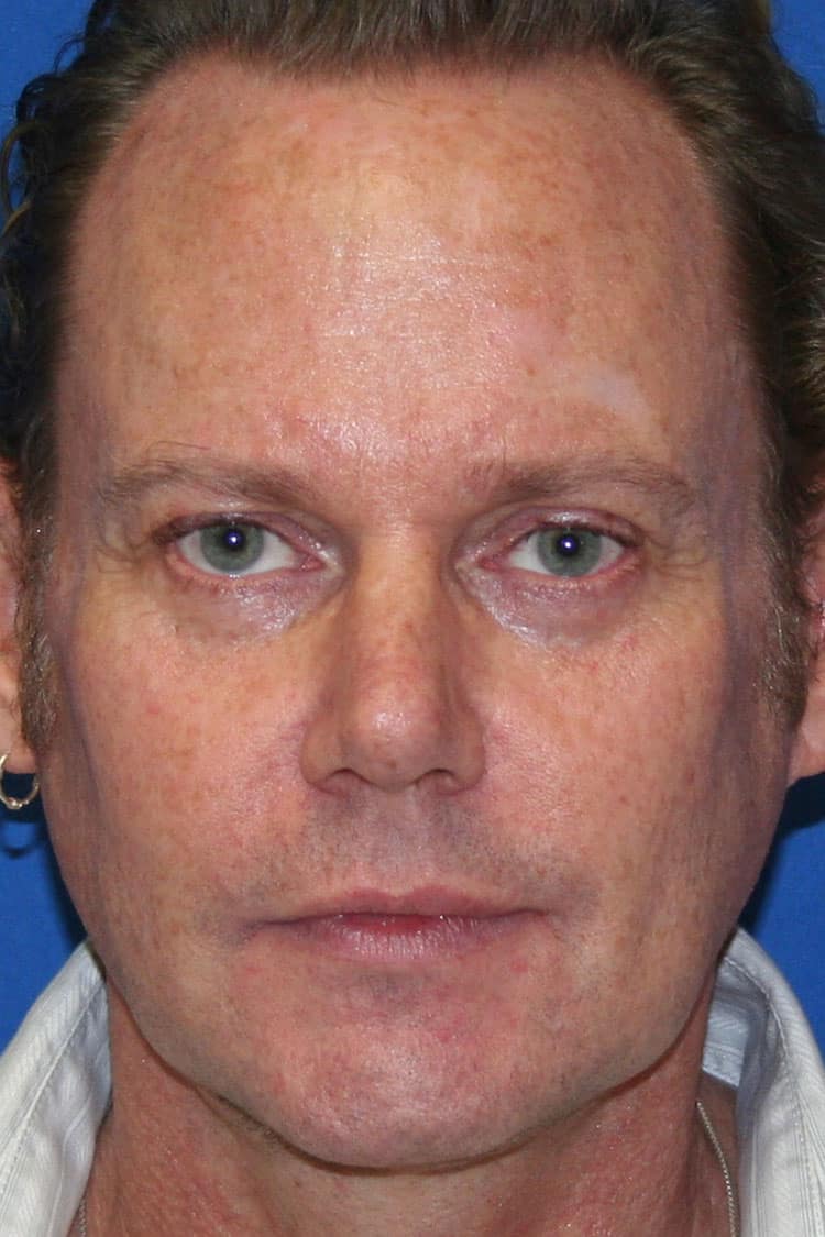 Remarkable, facial rejuvenation procedure how With you facial rejuvenation procedure are