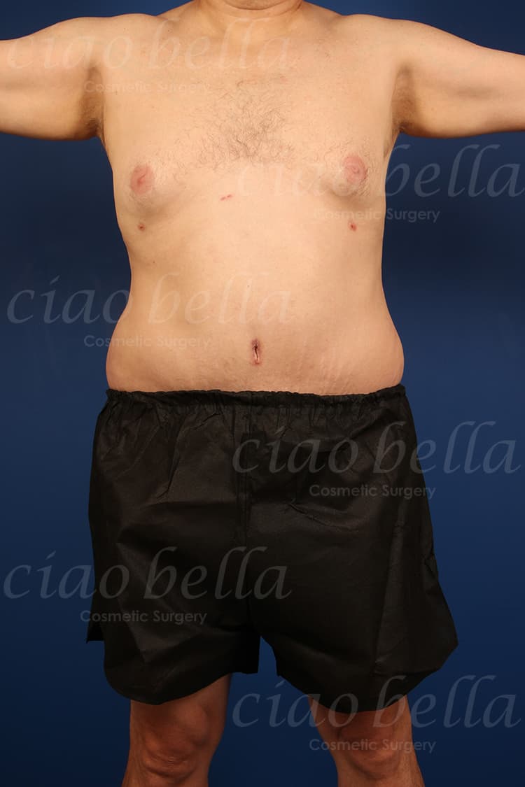 Liposuction  Bella Forme Medical