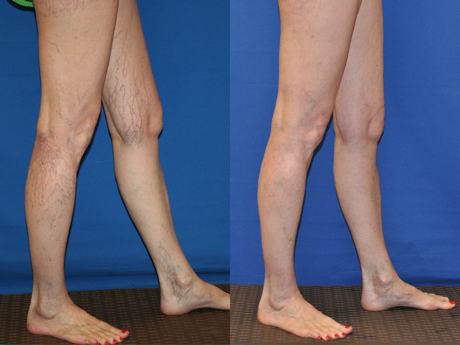 Spider Veins Patient Treated at Ciao Bella
