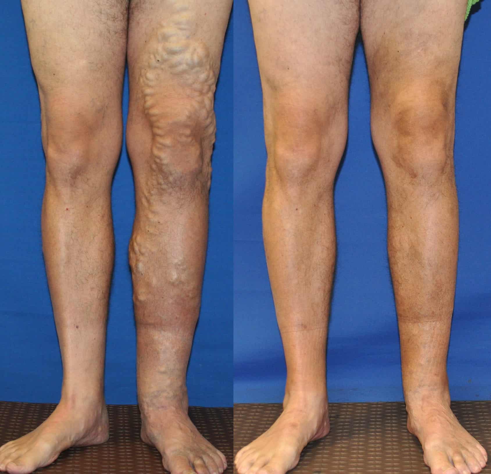 Varicose Veins Patient Treated at Ciao Bella