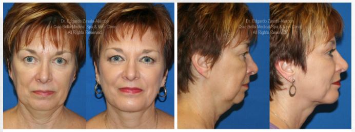 Facial Rejuvenation Patient - Before and After